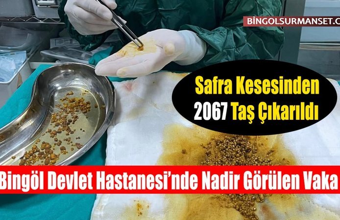 Safra Kesesinden 2067 Taş Çıkarıldı