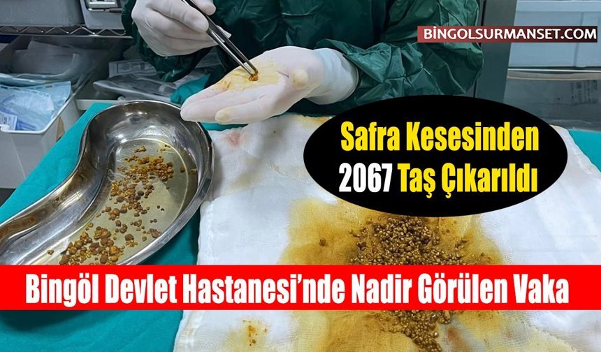Safra Kesesinden 2067 Taş Çıkarıldı