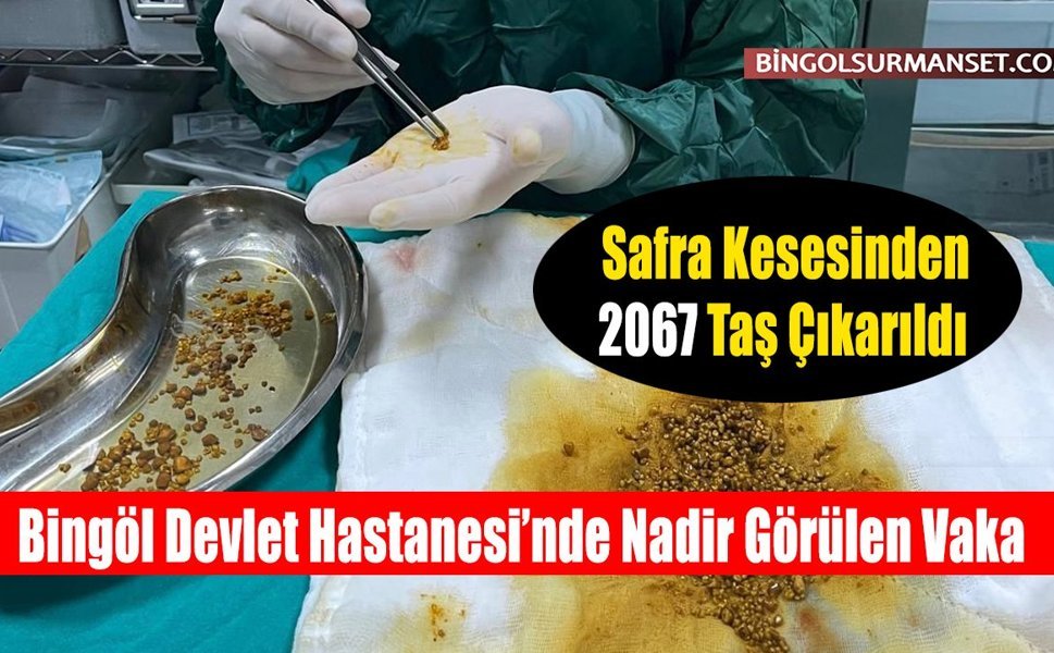 Safra Kesesinden 2067 Taş Çıkarıldı